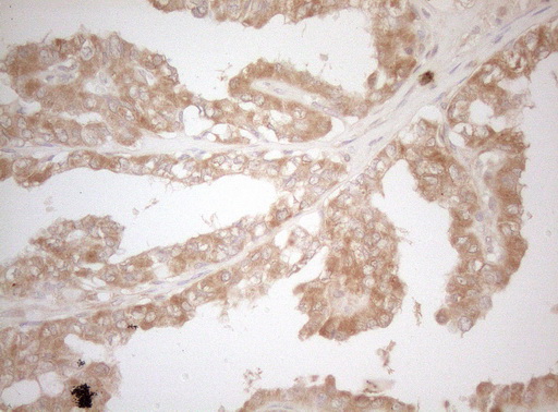 MS4A12 Antibody - Immunohistochemical staining of paraffin-embedded Carcinoma of Human thyroid tissue using anti-MS4A12 mouse monoclonal antibody. (Heat-induced epitope retrieval by 1mM EDTA in 10mM Tris buffer. (pH8.5) at 120°C for 3 min. (1:150)