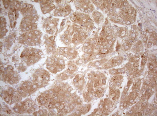 MS4A12 Antibody - Immunohistochemical staining of paraffin-embedded Carcinoma of Human liver tissue using anti-MS4A12 mouse monoclonal antibody. (Heat-induced epitope retrieval by 1mM EDTA in 10mM Tris buffer. (pH8.5) at 120°C for 3 min. (1:150)