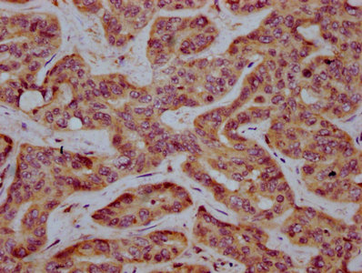 MS4A2 / FCERI Antibody - Immunohistochemistry Dilution at 1:400 and staining in paraffin-embedded human liver cancer performed on a Leica BondTM system. After dewaxing and hydration, antigen retrieval was mediated by high pressure in a citrate buffer (pH 6.0). Section was blocked with 10% normal Goat serum 30min at RT. Then primary antibody (1% BSA) was incubated at 4°C overnight. The primary is detected by a biotinylated Secondary antibody and visualized using an HRP conjugated SP system.