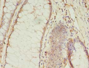 MS4A7 Antibody - Immunohistochemistry of paraffin-embedded human colon cancer using antibody at 1:100 dilution.