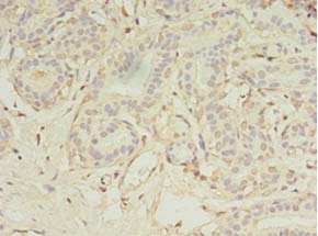 MS4A7 Antibody - Immunohistochemistry of paraffin-embedded human breast cancer using antibody at 1:100 dilution.