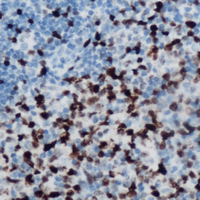 MSC / Musculin Antibody - Immunohistochemical analysis of Musculin staining in human lymphoma formalin fixed paraffin embedded tissue section. The section was pre-treated using heat mediated antigen retrieval with sodium citrate buffer (pH 6.0). The section was then incubated with the antibody at room temperature and detected using an HRP conjugated compact polymer system. DAB was used as the chromogen. The section was then counterstained with hematoxylin and mounted with DPX.
