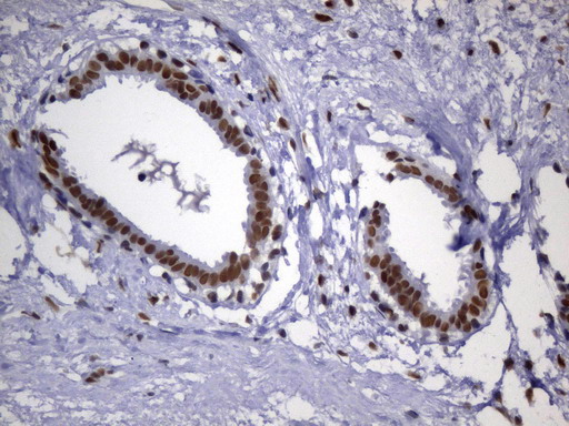 MSH2 Antibody - Immunohistochemical staining of paraffin-embedded Human breast tissue within the normal limits using anti-MSH2 mouse monoclonal antibody. (Heat-induced epitope retrieval by 1mM EDTA in 10mM Tris buffer. (pH8.0) at 120°C for 2.5 min. (1:2400)