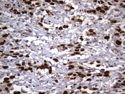 MSH2 Antibody - Immunohistochemical staining of paraffin-embedded Adenocarcinoma of Human ovary tissue using anti-MSH2 mouse monoclonal antibody. (Heat-induced epitope retrieval by 1mM EDTA in 10mM Tris buffer. (pH8.0) at 120°C for 2.5 min. (1:2400)
