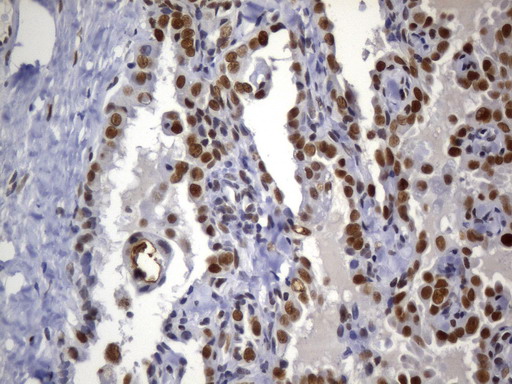 MSH2 Antibody - Immunohistochemical staining of paraffin-embedded Carcinoma of Human thyroid tissue using anti-MSH2 mouse monoclonal antibody. (Heat-induced epitope retrieval by 1mM EDTA in 10mM Tris buffer. (pH8.0) at 120°C for 2.5 min. (1:2400)