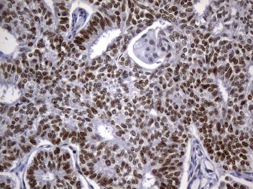 MSH2 Antibody - Immunohistochemical staining of paraffin-embedded Adenocarcinoma of Human endometrium tissue using anti-MSH2 mouse monoclonal antibody. (Heat-induced epitope retrieval by 1mM EDTA in 10mM Tris buffer. (pH8.0) at 120°C for 2.5 min. (1:2400)