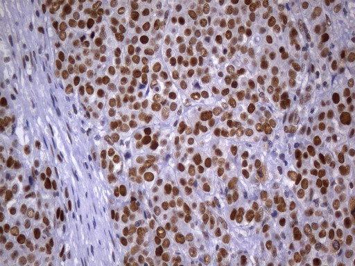 MSH2 Antibody - Immunohistochemical staining of paraffin-embedded Adenocarcinoma of Human breast tissue tissue using anti-MSH2 mouse monoclonal antibody. (Heat-induced epitope retrieval by 1mM EDTA in 10mM Tris buffer. (pH8.0) at 120°C for 2.5 min. (1:2400)