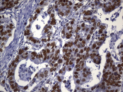 MSH2 Antibody - Immunohistochemical staining of paraffin-embedded Carcinoma of Human bladder tissue using anti-MSH2 mouse monoclonal antibody. (Heat-induced epitope retrieval by 1mM EDTA in 10mM Tris buffer. (pH8.0) at 120°C for 2.5 min. (1:2400)