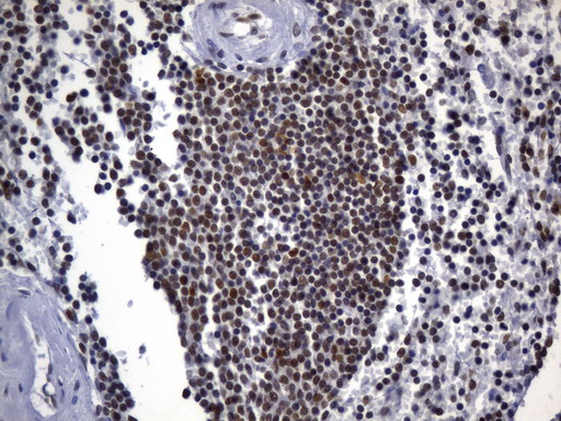 MSH2 Antibody - Immunohistochemical staining of paraffin-embedded Human lymph node tissue within the normal limits using anti-MSH2 mouse monoclonal antibody. (Heat-induced epitope retrieval by 1mM EDTA in 10mM Tris buffer. (pH8.0) at 120°C for 2.5 min. (1:2400)