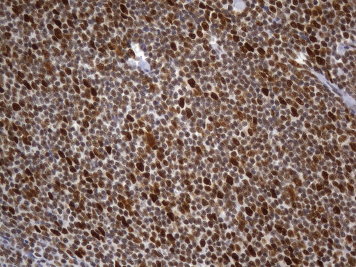 MSH2 Antibody - Immunohistochemical staining of paraffin-embedded Human lymphoma tissue using anti-MSH2 mouse monoclonal antibody. (Heat-induced epitope retrieval by 1mM EDTA in 10mM Tris buffer. (pH8.0) at 120°C for 2.5 min. (1:2400)