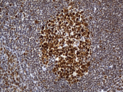 MSH2 Antibody - Immunohistochemical staining of paraffin-embedded Human tonsil within the normal limits using anti-MSH2 mouse monoclonal antibody. (Heat-induced epitope retrieval by 1mM EDTA in 10mM Tris buffer. (pH8.0) at 120°C for 2.5 min. (1:2400)