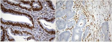 MSH2 Antibody - Immunohistochemical staining of paraffin-embedded Adenocarcinoma of Human colon tissue using anti-MSH2 mouse monoclonal antibody. (Heat-induced epitope retrieval by 1mM EDTA in 10mM Tris buffer. (pH8.0) at 120°C for 2.5 min. (1:2400)
