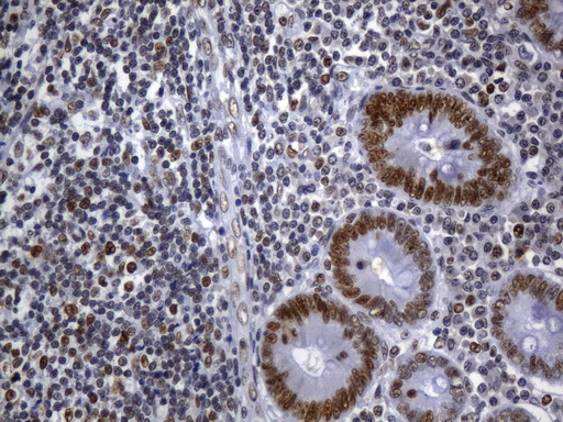 MSH2 Antibody - Immunohistochemical staining of paraffin-embedded Human appendix tissue within the normal limits using anti-MSH2 mouse monoclonal antibody. (Heat-induced epitope retrieval by 1mM EDTA in 10mM Tris buffer. (pH8.0) at 120°C for 2.5 min. (1:2400)