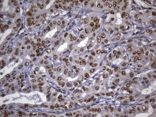 MSH2 Antibody - Immunohistochemical staining of paraffin-embedded Carcinoma of Human liver tissue using anti-MSH2 mouse monoclonal antibody. (Heat-induced epitope retrieval by 1mM EDTA in 10mM Tris buffer. (pH8.0) at 120°C for 2.5 min. (1:2400)