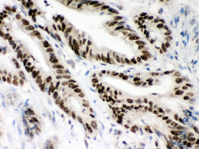 MSH2 Antibody - MSH2 antibody IHC-paraffin: Human Intestinal Cancer Tissue.