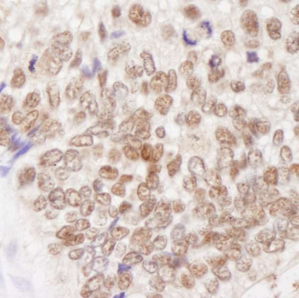 MSH2 Antibody - Detection of Human MSH2 by Immunohistochemistry. Sample: FFPE section of human colon adenocarcinoma. Antibody: Affinity purified rabbit anti-MSH2 used at a dilution of 1:250. Detection: DAB staining using anti-Rabbit IHC antibody at a dilution of 1:100.