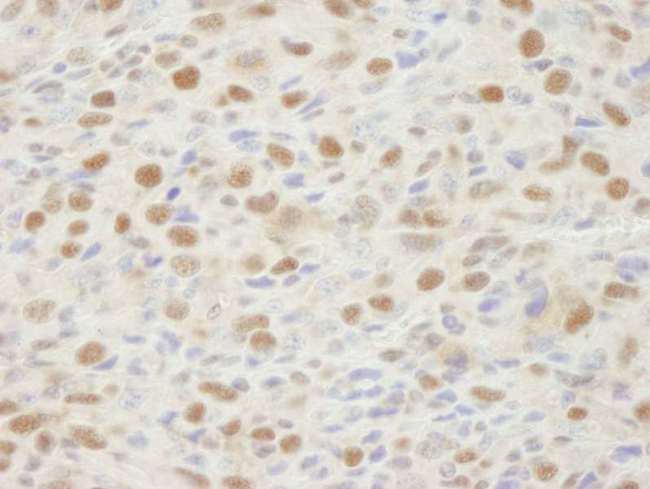 MSH2 Antibody - Detection of Mouse MSH2 by Immunohistochemistry. Sample: FFPE section of mouse squamous cell carcinoma. Antibody: Affinity purified rabbit anti-MSH2 used at a dilution of 1:250. Detection: DAB staining using anti-Rabbit IHC antibody at a dilution of 1:100.