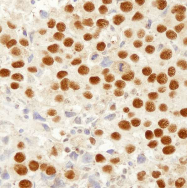 MSH2 Antibody - Detection of Human MSH2 by Immunohistochemistry. Sample: FFPE section of human seminoma. Antibody: Affinity purified rabbit anti-MSH2 used at a dilution of 1:250. Detection: DAB staining using anti-Rabbit IHC antibody at a dilution of 1:100.