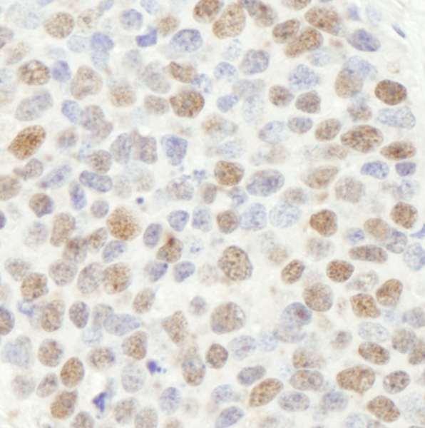 MSH2 Antibody - Detection of Human MSH2 by Immunohistochemistry. Sample: FFPE section of human lung small cell carcinoma. Antibody: Affinity purified rabbit anti-MSH2 used at a dilution of 1:250. Detection: DAB staining using anti-Rabbit IHC antibody at a dilution of 1:100.