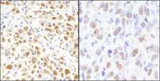 MSH2 Antibody - Detection of Human and Mouse MSH2 by Immunohistochemistry. Sample: FFPE section of human metastatic lymph node (left) and mouse squamous cell carcinoma (right). Antibody: Affinity purified rabbit anti-MSH2 used at a dilution of 1:1000 (1and 1:5000 (0.2 Detection: DAB.
