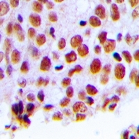 MSH2 Antibody - Immunohistochemical analysis of MSH2 staining in human breast cancer formalin fixed paraffin embedded tissue section. The section was pre-treated using heat mediated antigen retrieval with sodium citrate buffer (pH 6.0). The section was then incubated with the antibody at room temperature and detected with HRP and DAB as chromogen. The section was then counterstained with hematoxylin and mounted with DPX.