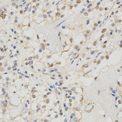 MSH2 Antibody - Immunohistochemistry of paraffin-embedded human kidney cancer using MSH2 antibody at dilution of 1:200 (x400 lens).