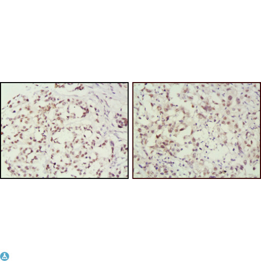 MSH2 Antibody - Immunohistochemistry (IHC) analysis of paraffin-embedded Human Breast cancer (left) and lung cancer (right) tissues, showing nuclear localization with DAB staining using MSH2 Monoclonal Antibody.