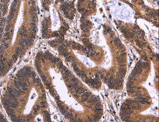 MSH4 Antibody - Immunohistochemistry of paraffin-embedded Human cervical cancer using MSH4 Polyclonal Antibody at dilution of 1:50.