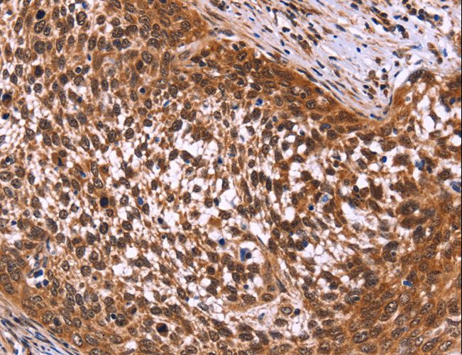 MSH4 Antibody - Immunohistochemistry of paraffin-embedded Human cervical cancer using MSH4 Polyclonal Antibody at dilution of 1:50.