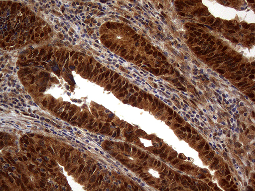MSH6 Antibody - Immunohistochemical staining of paraffin-embedded Adenocarcinoma of Human colon tissue using anti-MSH6 mouse monoclonal antibody. (Heat-induced epitope retrieval by 1mM EDTA in 10mM Tris buffer. (pH8.5) at 120°C for 3 min. (1:150)