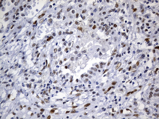 MSH6 Antibody - Immunohistochemical staining of paraffin-embedded human lung carcinoma tissue using anti-MSH6 mouse monoclonal antibody. (Heat-induced epitope retrieval by 1mM EDTA in 10mM Tris buffer. (pH9.0) at 120°C for 3 min. (1:50)
