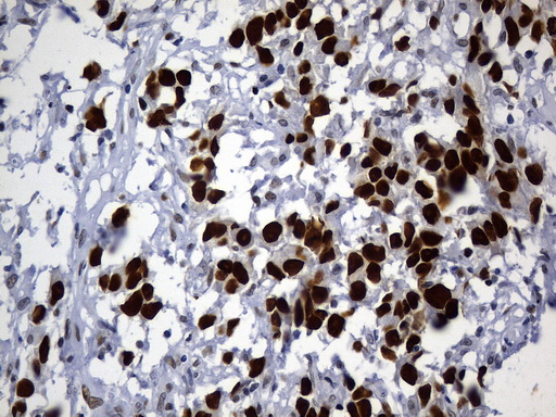 MSH6 Antibody - Immunohistochemical staining of paraffin-embedded human ovarian adenocarcinoma tissue using anti-MSH6 mouse monoclonal antibody. (Heat-induced epitope retrieval by 1mM EDTA in 10mM Tris buffer. (pH9.0) at 120°C for 3 min. (1:50)