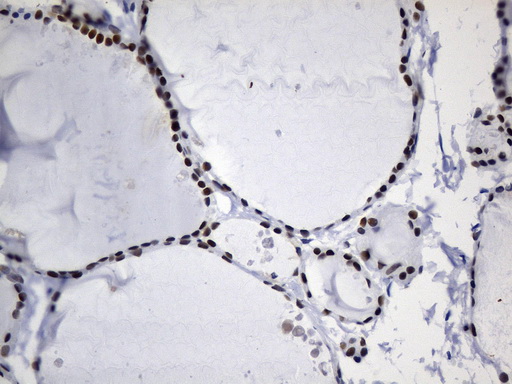 MSH6 Antibody - Immunohistochemical staining of paraffin-embedded human thyroid tissue within the normal limits using anti-MSH6 mouse monoclonal antibody. (Heat-induced epitope retrieval by 1mM EDTA in 10mM Tris buffer. (pH9.0) at 120°C for 3 min. (1:50)
