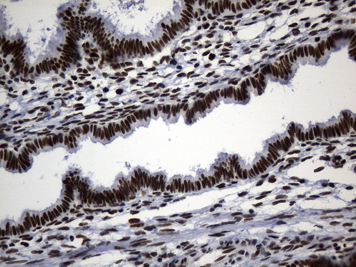 MSH6 Antibody - Immunohistochemical staining of paraffin-embedded human endometrium tissue within the normal limits using anti-MSH6 mouse monoclonal antibody. (Heat-induced epitope retrieval by 1mM EDTA in 10mM Tris buffer. (pH9.0) at 120°C for 3 min. (1:50)