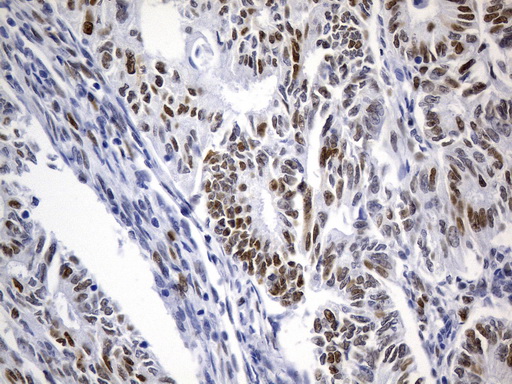 MSH6 Antibody - Immunohistochemical staining of paraffin-embedded human endometrium adenocarcinoma tissue using anti-MSH6 mouse monoclonal antibody. (Heat-induced epitope retrieval by 1mM EDTA in 10mM Tris buffer. (pH9.0) at 120°C for 3 min. (1:50)