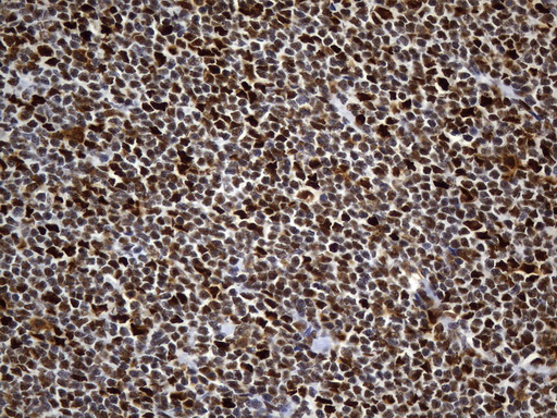 MSH6 Antibody - Immunohistochemical staining of paraffin-embedded human lymphoma tissue using anti-MSH6 mouse monoclonal antibody. (Heat-induced epitope retrieval by 1mM EDTA in 10mM Tris buffer. (pH9.0) at 120°C for 3 min. (1:50)