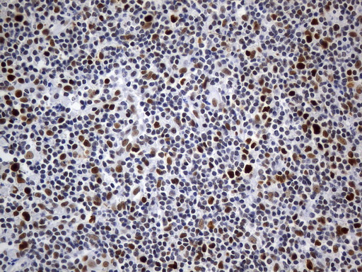 MSH6 Antibody - Immunohistochemical staining of paraffin-embedded human tonsil within the normal limits using anti-MSH6 mouse monoclonal antibody. (Heat-induced epitope retrieval by 1mM EDTA in 10mM Tris buffer. (pH9.0) at 120°C for 3 min. (1:50)