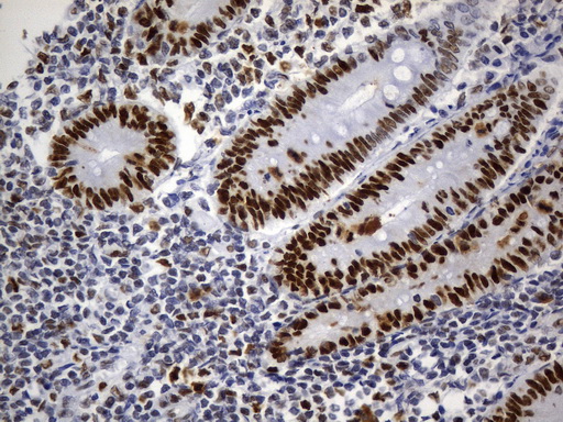 MSH6 Antibody - Immunohistochemical staining of paraffin-embedded human urothelial carcinoma using anti-MSH6 mouse monoclonal antibody. (Heat-induced epitope retrieval by 1mM EDTA in 10mM Tris buffer. (pH9.0) at 120°C for 3 min. (1:50)