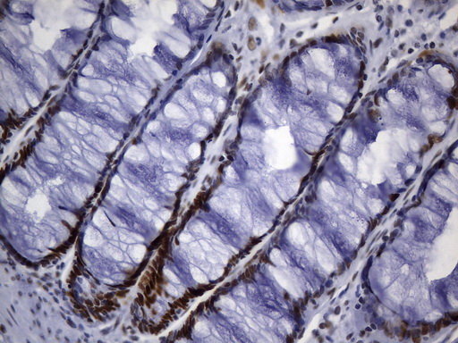 MSH6 Antibody - Immunohistochemical staining of paraffin-embedded human colon tissue within the normal limits using anti-MSH6 mouse monoclonal antibody. (Heat-induced epitope retrieval by 1mM EDTA in 10mM Tris buffer. (pH9.0) at 120°C for 3 min. (1:50)