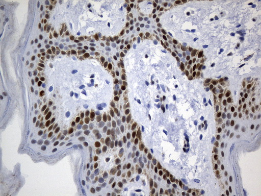 MSH6 Antibody - Immunohistochemical staining of paraffin-embedded human skin tissue within the normal limits using anti-MSH6 mouse monoclonal antibody. (Heat-induced epitope retrieval by 1mM EDTA in 10mM Tris buffer. (pH9.0) at 120 oC for 3 min. (1:50)
