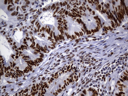 MSH6 Antibody - Immunohistochemical staining of paraffin-embedded human colon adenocarcinoma tissue using anti-MSH6 mouse monoclonal antibody. (Heat-induced epitope retrieval by 1mM EDTA in 10mM Tris buffer. (pH9.0) at 120°C for 3 min. (1:50)