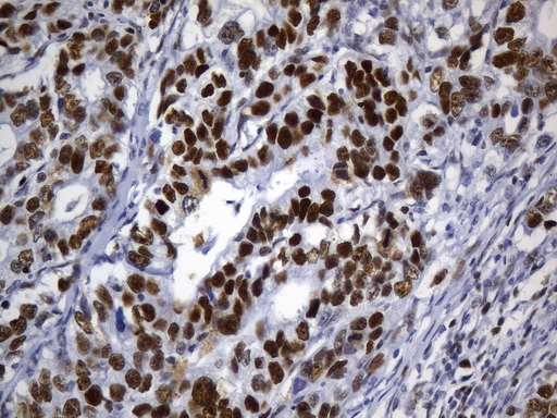 MSH6 Antibody - Immunohistochemical staining of paraffin-embedded human gastric carcinoma using anti-MSH6 mouse monoclonal antibody. (Heat-induced epitope retrieval by 1mM EDTA in 10mM Tris buffer. (pH9.0) at 120°C for 3 min. (1:50)