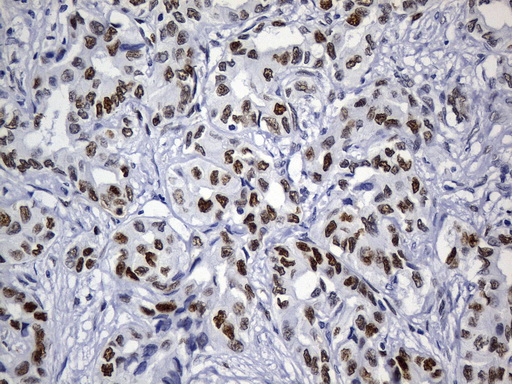 MSH6 Antibody - Immunohistochemical staining of paraffin-embedded human liver carcinomatissue using anti-MSH6 mouse monoclonal antibody. (Heat-induced epitope retrieval by 1mM EDTA in 10mM Tris buffer. (pH9.0) at 120°C for 3 min. (1:50)