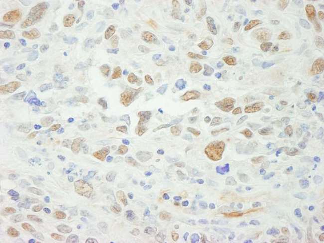 MSH6 Antibody - Detection of Human MSH6 by Immunohistochemistry. Sample: FFPE section of human metastatic lymph node. Antibody: Affinity purified rabbit anti-MSH6 used at a dilution of 1:500 (2 Detection: DAB.