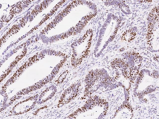 MSH6 Antibody - Immunochemical staining of human MSH6 in human colon carcinoma with rabbit monoclonal antibody at 1:200 dilution, formalin-fixed paraffin embedded sections.