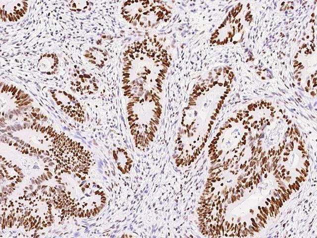 MSH6 Antibody - Immunochemical staining of human MSH6 in human sigmoid colon cancer with rabbit monoclonal antibody at 1:200 dilution, formalin-fixed paraffin embedded sections.