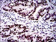 MSH6 Antibody - IHC of paraffin-embedded rectum cancer tissues using MSH6 mouse monoclonal antibody with DAB staining.