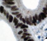 MSH6 Antibody - IHC of MSH6 on FFPE Colon Carcinoma tissue.