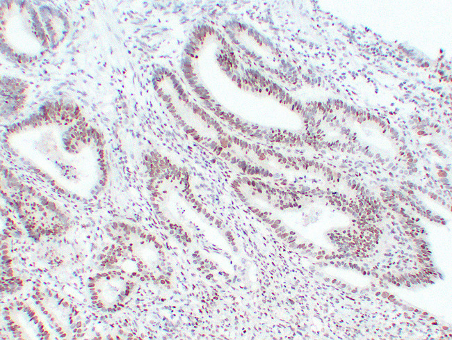 MSH6 Antibody - Colon Carcinoma 1