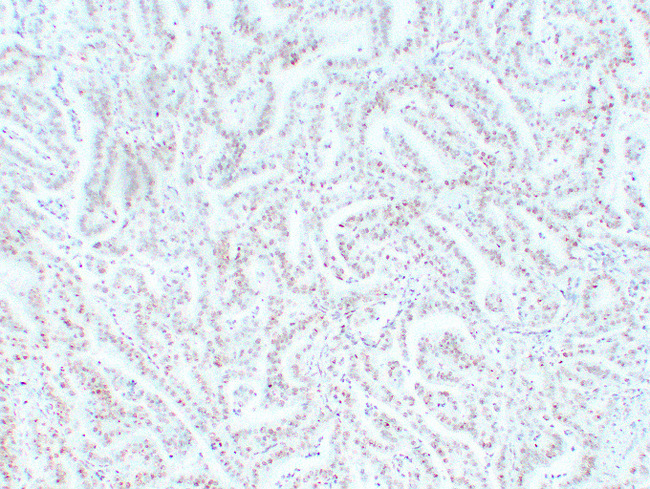MSH6 Antibody - Colon Carcinoma 2